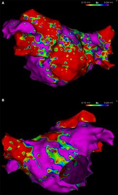 Ongoing substrate-driven atrial fibrillation “boxed” in the left atrial posterior wall with ablation: a case report